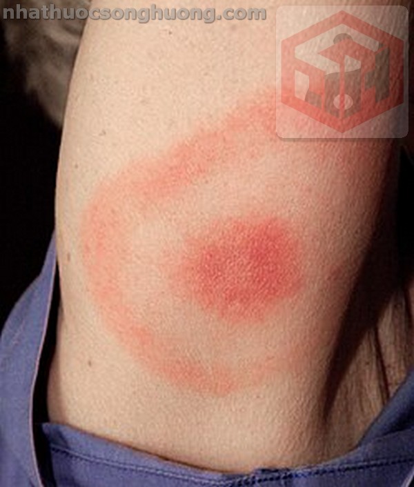Bệnh Lyme và cây Câu đằng