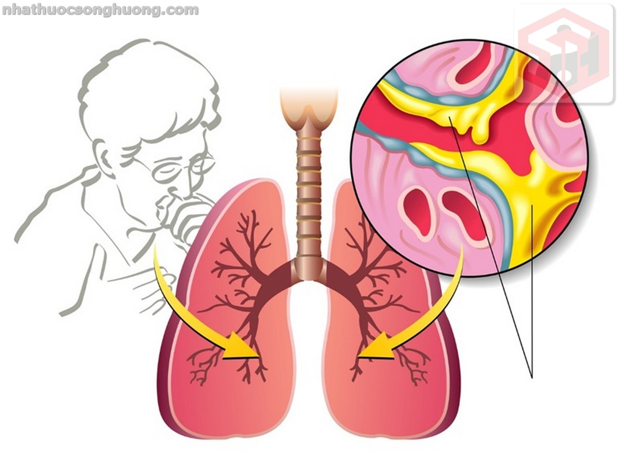 cây viễn chí có tác dụng chữa ho và giảm đờm