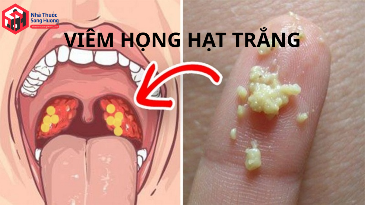 Hình ảnh viêm họng hạt trắng với các hạt trắng ở thành sau họng