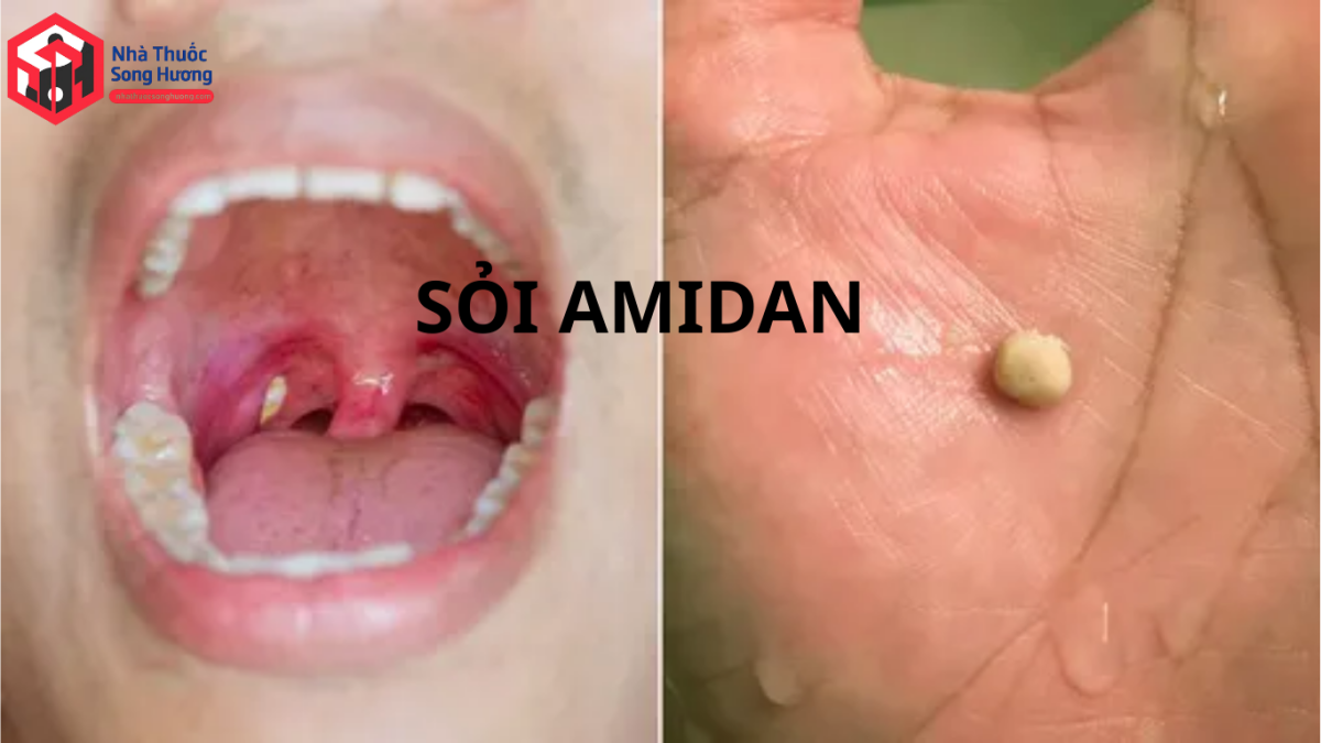 Sỏi amidan màu trắng vàng nằm trong hốc amidan