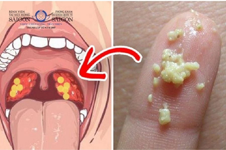 So sánh viêm họng hạt, sỏi amidan và nấm candida