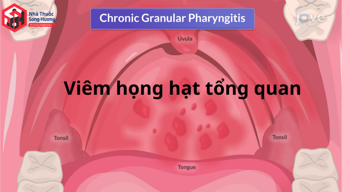Hình ảnh thành sau họng có các hạt lympho phì đại màu đỏ hồng