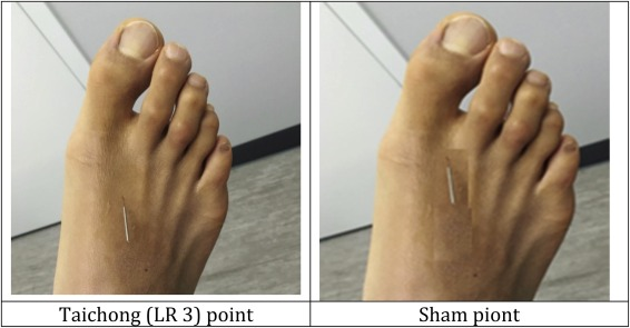 Huyệt thái xung là gì?