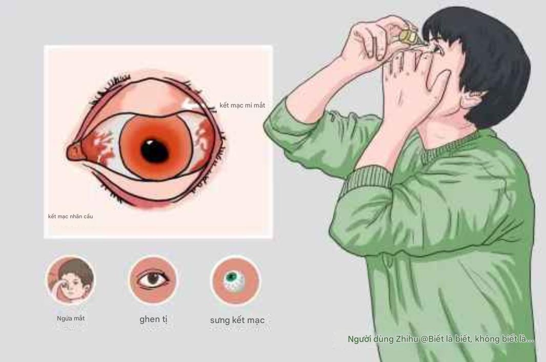 Mắt đỏ do phong nhiệt