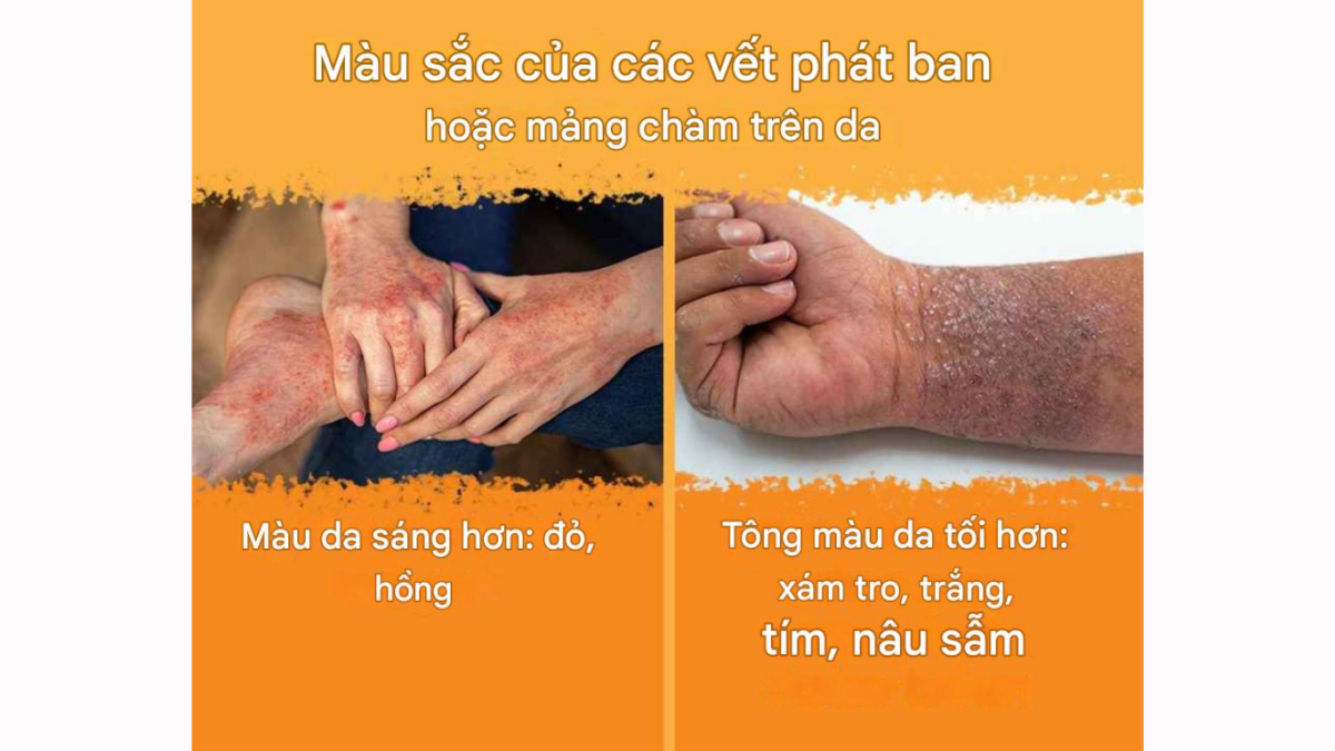bệnh chàm là gì viêm da cơ địa