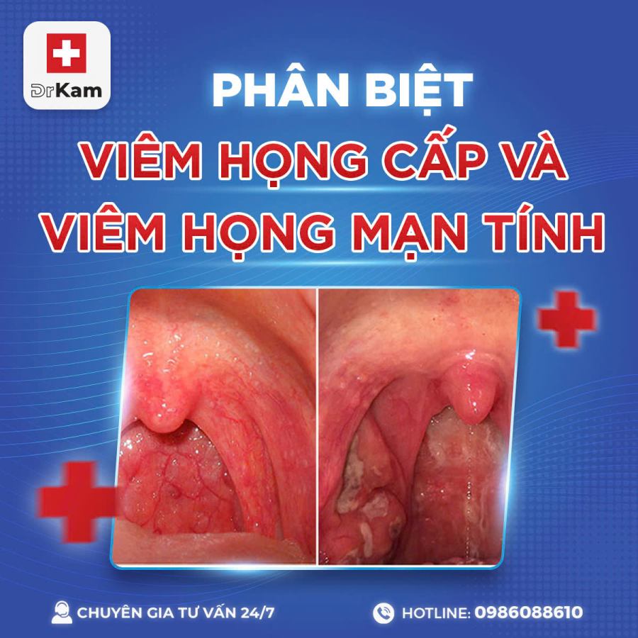 So sánh họng đỏ cấp tính và họng có hạt mạn tính