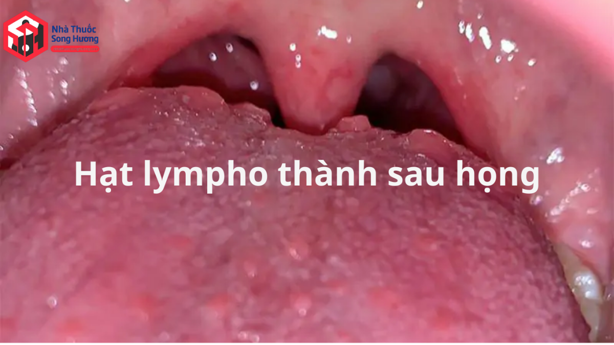 Cận cảnh các nốt hồng nhỏ rải rác ở thành sau họng