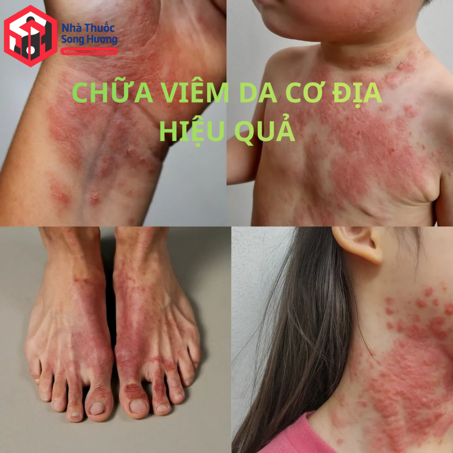 cách chữa eczema hiệu quả