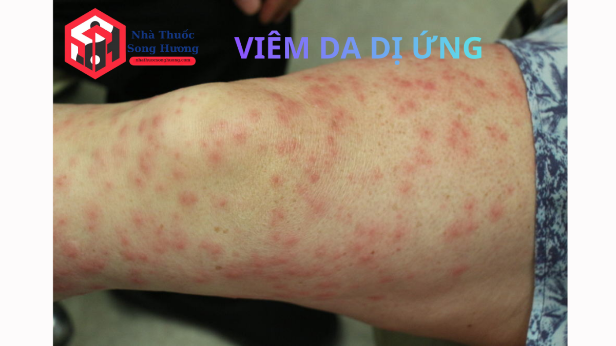 viêm da dị ứng triệu chứng