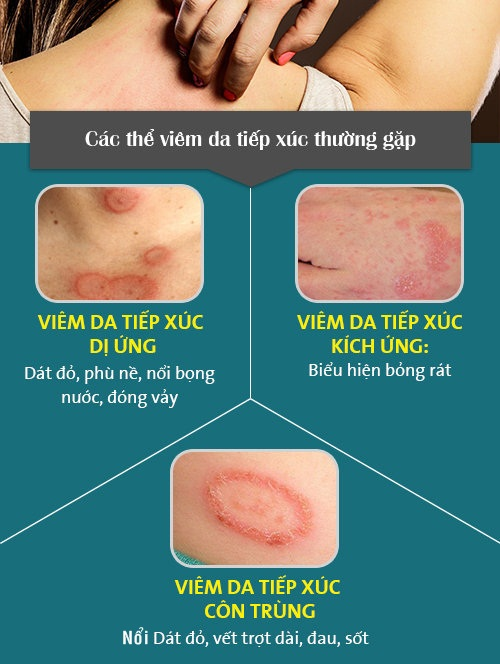 viêm da tiếp xúc kích ứng