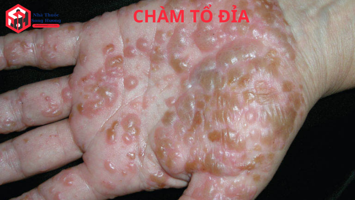 chàm tổ đỉa mụn nước tay chân