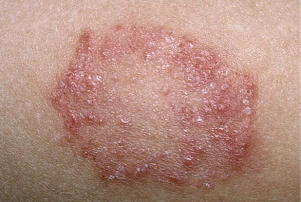 chàm đồng tiền hình tròn