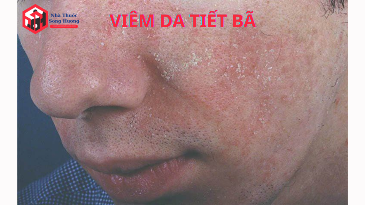 viêm da tiết bã da đầu