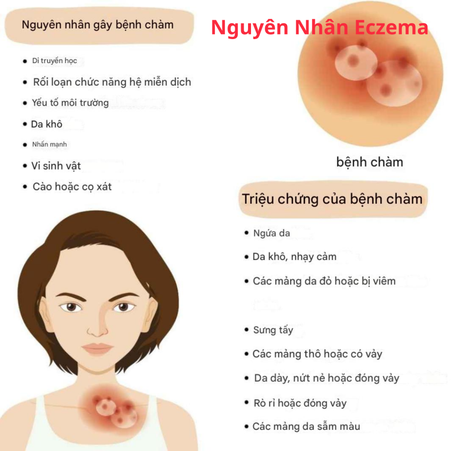 nguyên nhân gây bệnh chàm