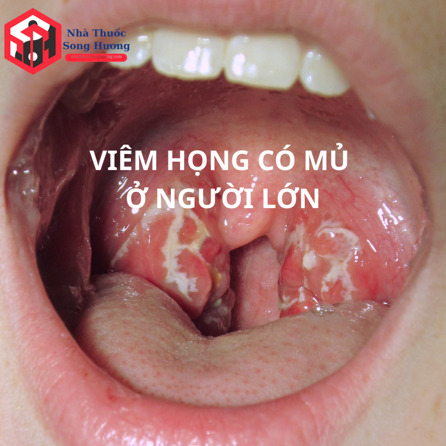 Hình ảnh viêm họng có mủ ở người lớn với mảng trắng vàng trên amidan