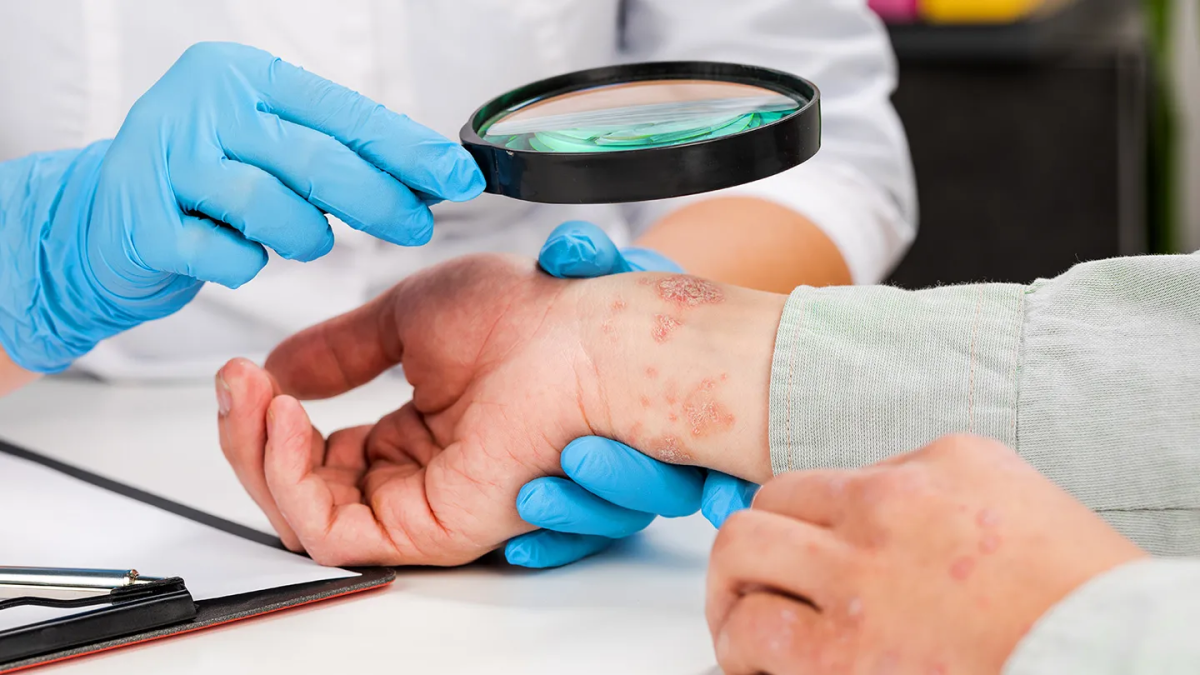 chẩn đoán bệnh chàm