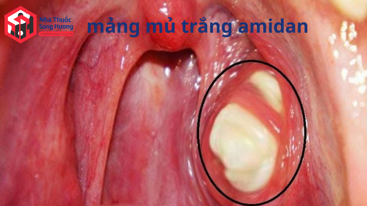 Mảng mủ trắng vàng bám trên amidan do nhiễm khuẩn
