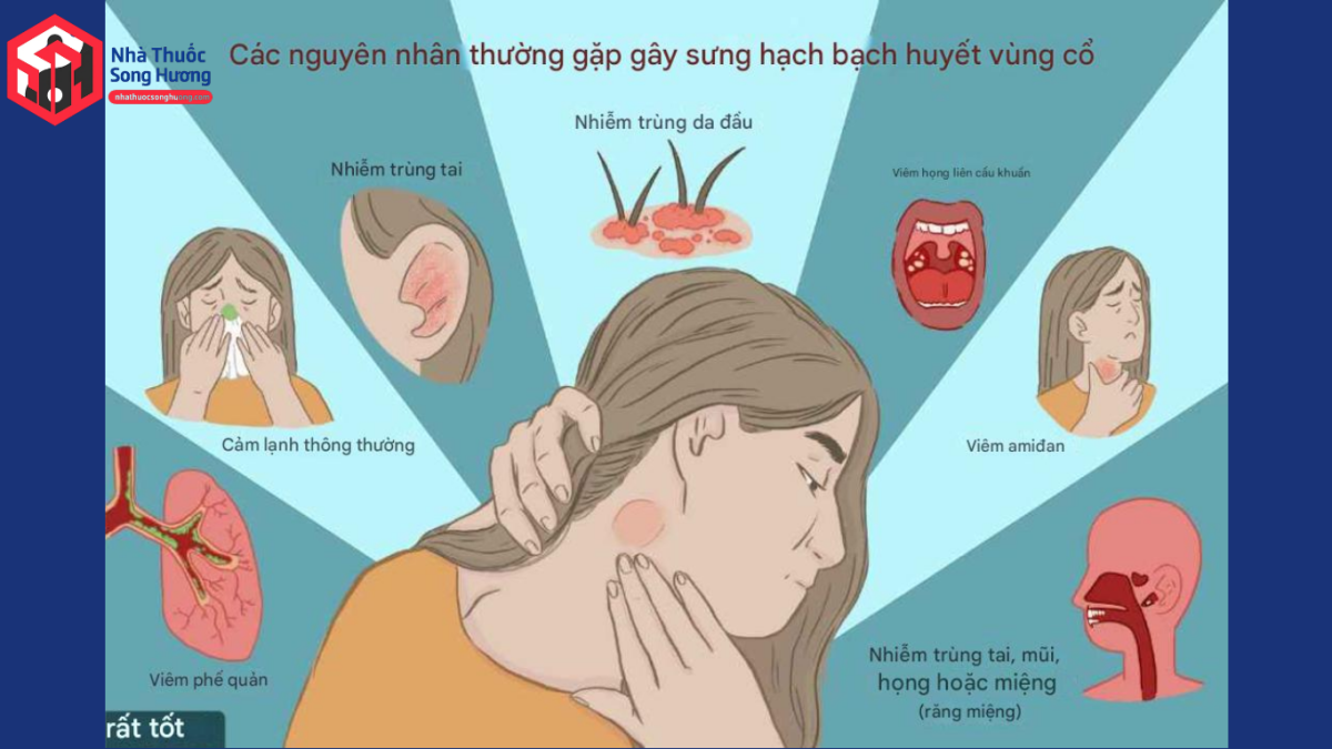 Hạch cổ sưng đau khi bị viêm họng mủ