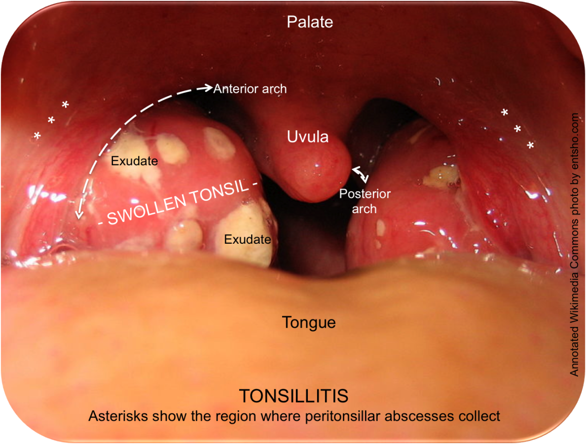 Áp xe quanh amidan gây lệch lưỡi gà