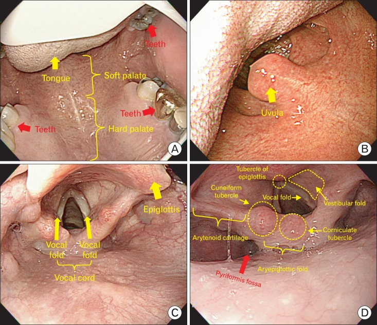 Bác sĩ soi họng phát hiện mảng mủ